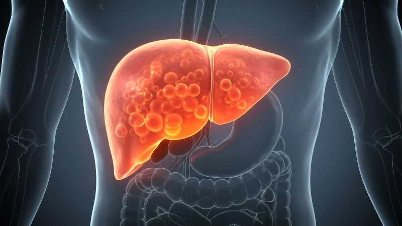 цирроз печени