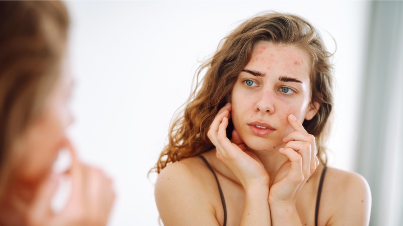 демодекоз на лице