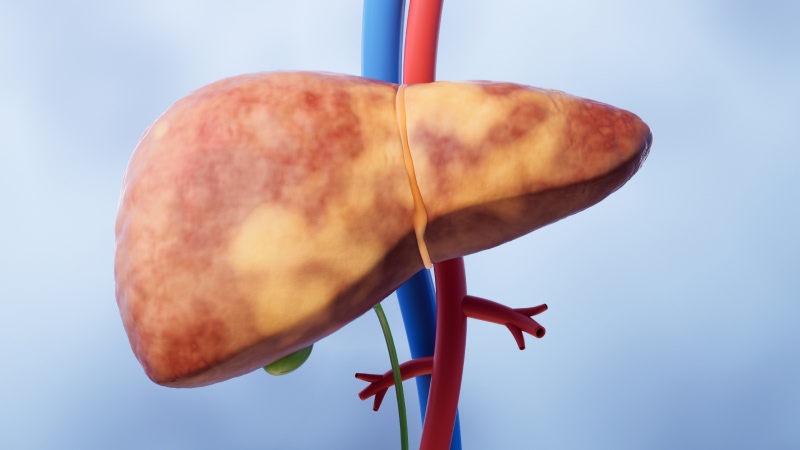 неалкогольная болезнь печени